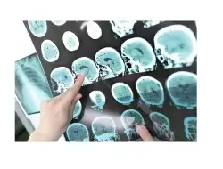 Tumor Otak: Mengenali Penyebab, Gejala, Diagnosis, dan Pengobatan