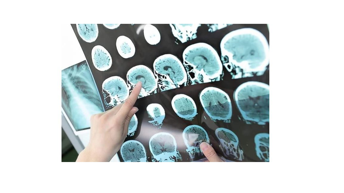 Tumor Otak - Mengenali Penyebab, Gejala, Diagnosis, dan Pengobatan