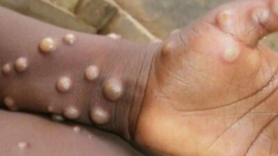 Empat Kasus Monkeypox Dikonfirmasi Di Brussels Belgia