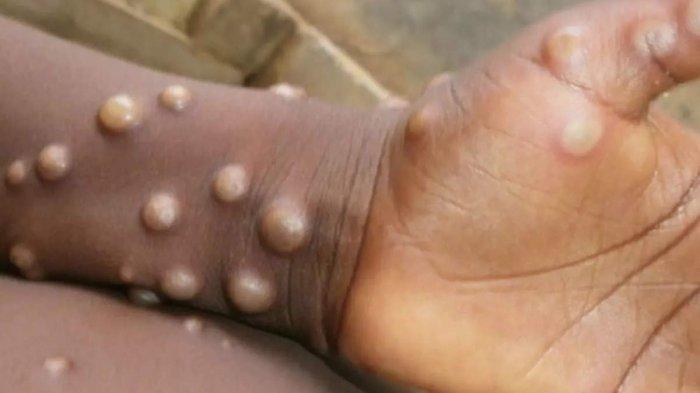 Empat Kasus Monkeypox Dikonfirmasi Di Brussels Belgia