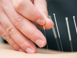 7 Kegunaan Terapi Akupunktur dalam Pengobatan