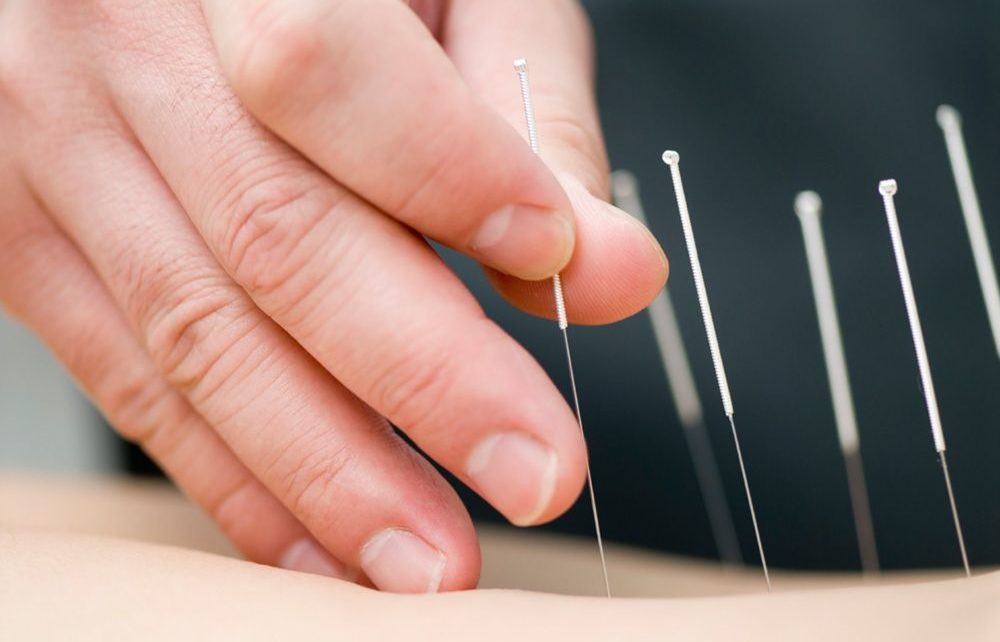 Kegunaan Terapi Akupunktur dalam Pengobatan