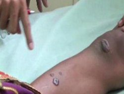 Wabah Antraks Di Gunungkidul DIY: 93 Warga Terinfeksi