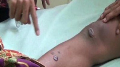 Wabah Antraks Di Gunungkidul DIY: 93 Warga Terinfeksi, Kemenkes Menyatakan Daerah Tersebut Endemik